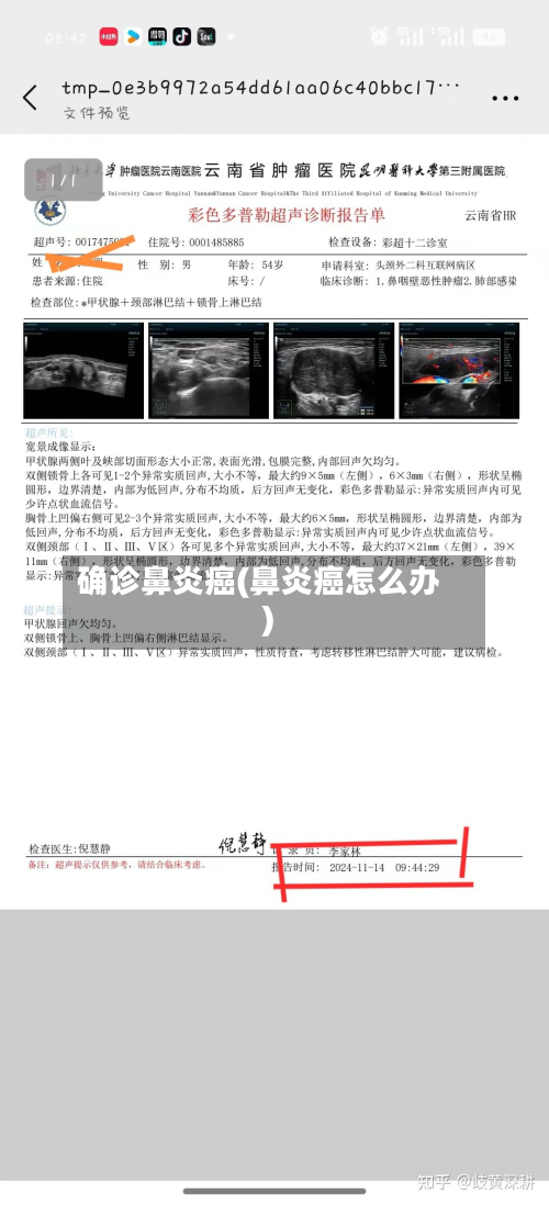 确诊鼻炎癌(鼻炎癌怎么办)-第2张图片