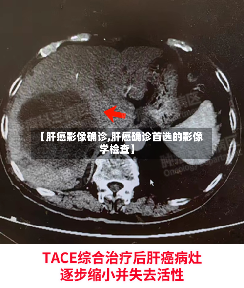 【肝癌影像确诊,肝癌确诊首选的影像学检查】-第2张图片