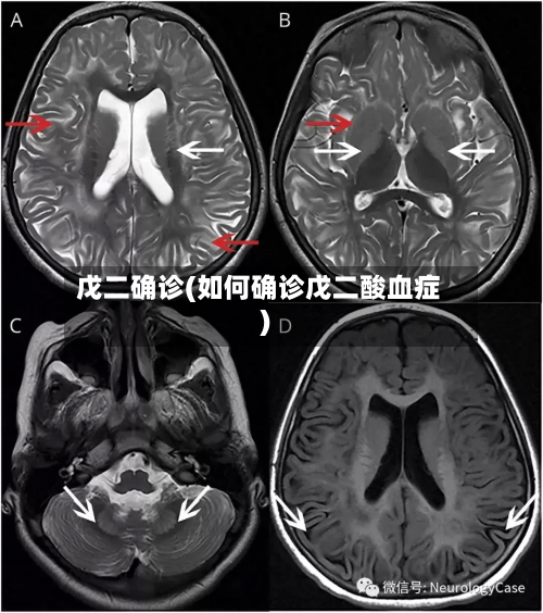戊二确诊(如何确诊戊二酸血症)