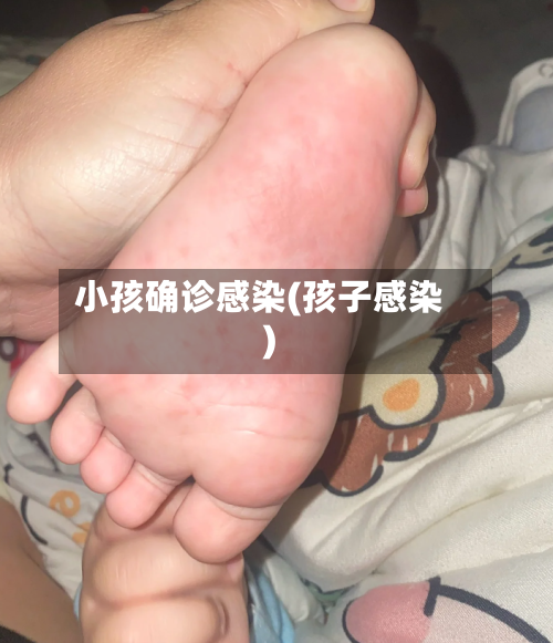 小孩确诊感染(孩子感染)