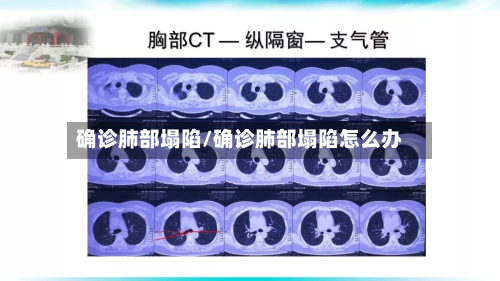 确诊肺部塌陷/确诊肺部塌陷怎么办-第3张图片