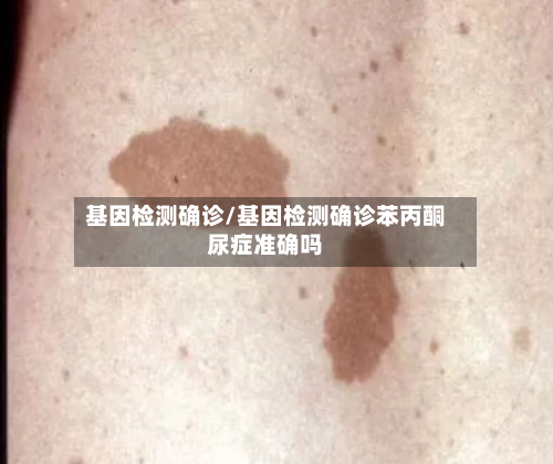 基因检测确诊/基因检测确诊苯丙酮尿症准确吗-第2张图片