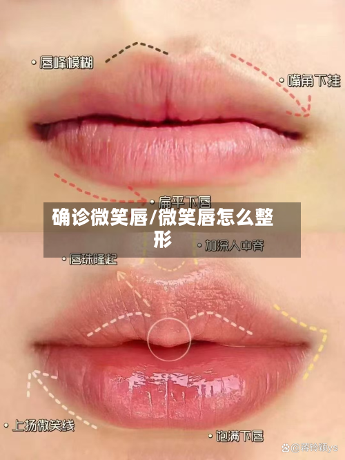 确诊微笑唇/微笑唇怎么整形-第2张图片