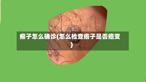 瘊子怎么确诊(怎么检查痦子是否癌变)-第2张图片