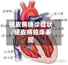 硬皮病确诊症状/硬皮病临床表现