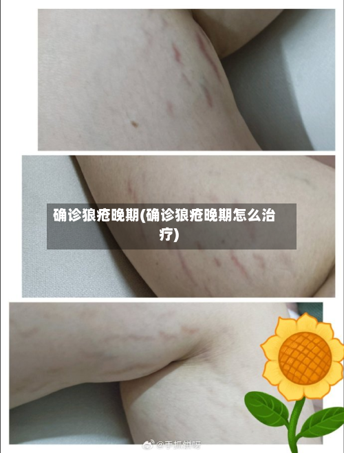 确诊狼疮晚期(确诊狼疮晚期怎么治疗)
