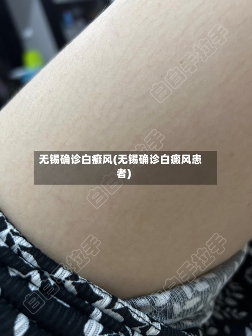 无锡确诊白癜风(无锡确诊白癜风患者)-第2张图片