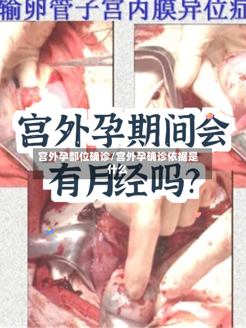 宫外孕部位确诊/宫外孕确诊依据是什么