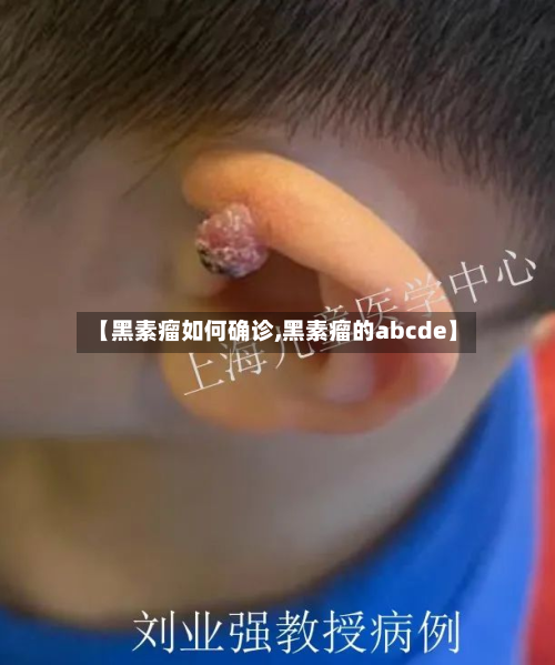 【黑素瘤如何确诊,黑素瘤的abcde】-第2张图片