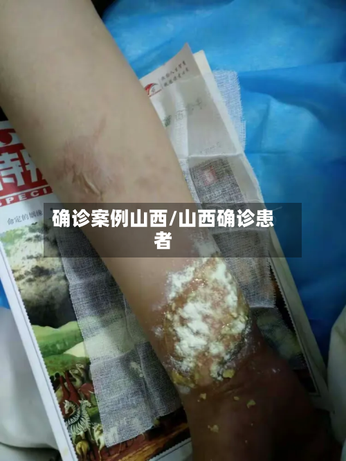 确诊案例山西/山西确诊患者