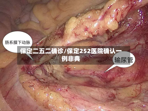 保定二五二确诊/保定252医院确认一例非典