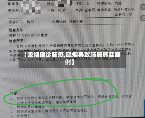 【吸烟确诊肺癌,吸烟导致肺癌真实案例】-第2张图片