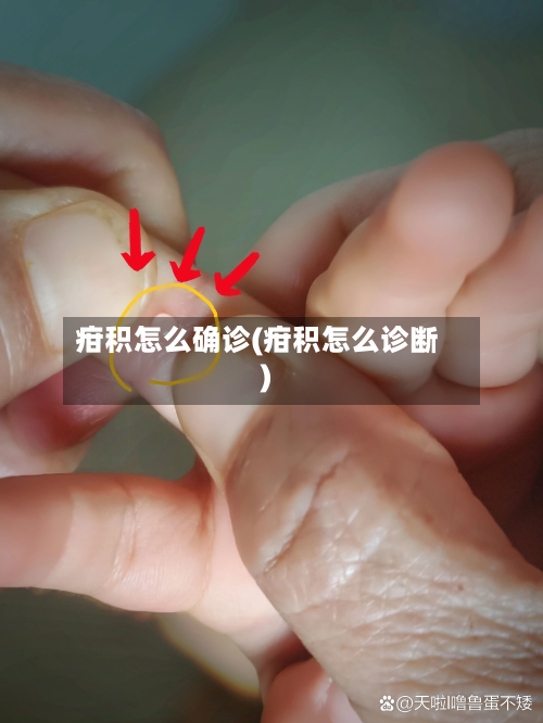 疳积怎么确诊(疳积怎么诊断)