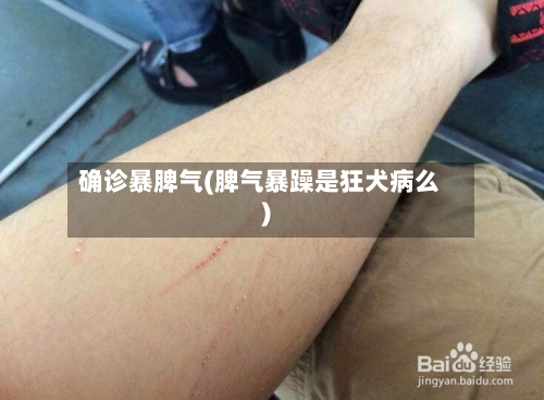 确诊暴脾气(脾气暴躁是狂犬病么)